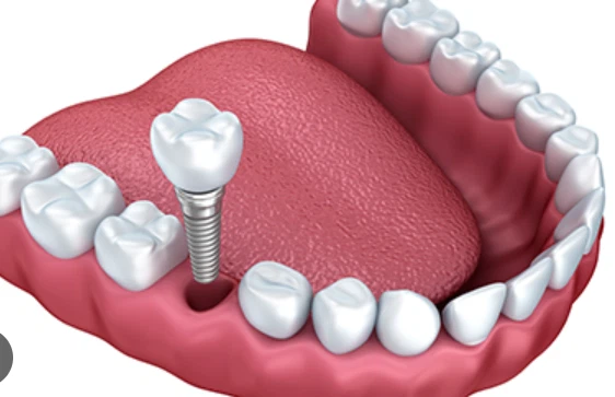 Titanium in Body Side Effects