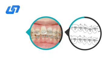 Fil d'arc orthodontique Niti Color